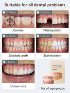 Custom-Fit Instant Smile Dentures – Natural Looking Comfort Fit