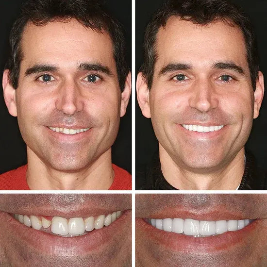 Custom-Fit Instant Smile Dentures – Natural Looking Comfort Fit
