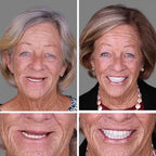 Custom-Fit Instant Smile Dentures – Natural Looking Comfort Fit