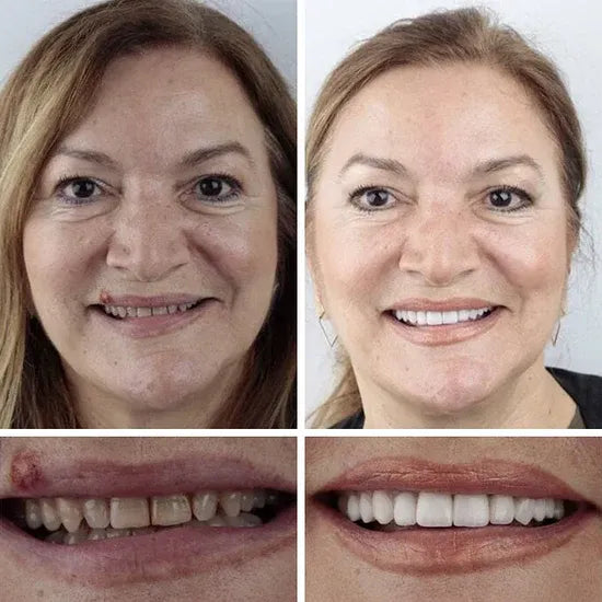 Custom-Fit Instant Smile Dentures – Natural Looking Comfort Fit